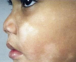 Pityriasis Alba